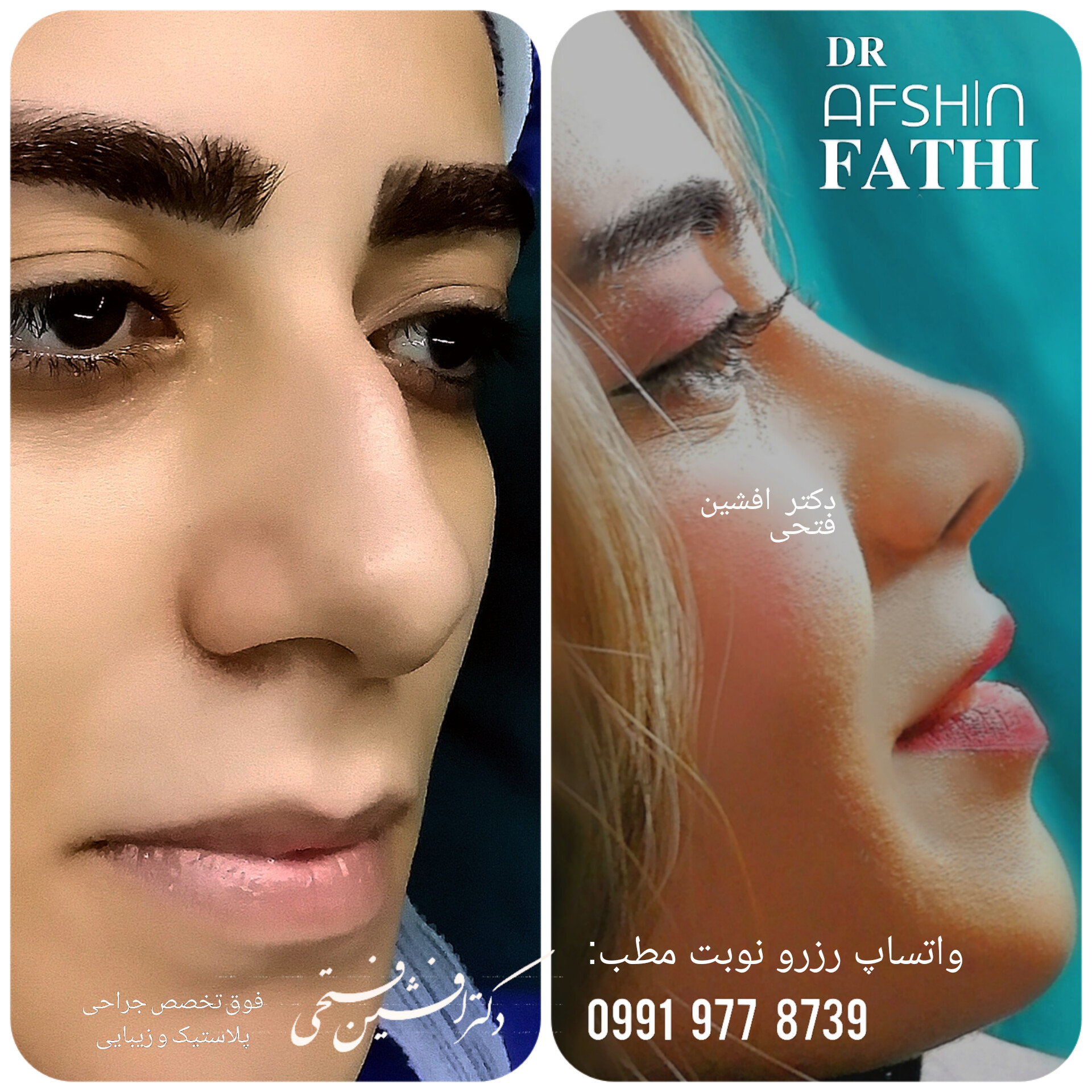 گالری فیلم - رینوپلاستی