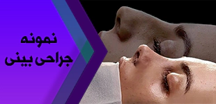  نمونه جراحی بینی